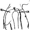 Пункция плечевого сустава