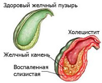 Боли в суставах при холецистите - анализы, классификация, лекарства, проявления