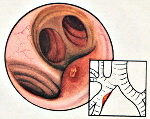 Туберкулез бронхов