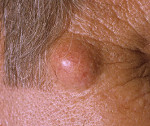Steatocystoma что это такое. Смотреть фото Steatocystoma что это такое. Смотреть картинку Steatocystoma что это такое. Картинка про Steatocystoma что это такое. Фото Steatocystoma что это такое