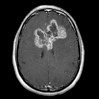 d05220724560b29ae5bcc86d10afbac7 опухоль бабочка головного мозга