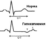 Гипокалиемия Гипокалиемия