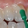 Ремотерапия (реминерализация зубов)