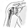 Эндопротезирование плечевого сустава