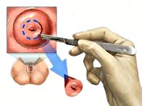 Процедура Биопсия шейки матки