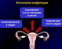 Акушерский перитонит