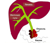 Контрольная работа по теме Этиология опухолей. Клинические проявления гемолитической желтухи