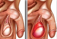 Болит левое яичко и опухло