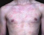Фолликулярный муциноз Фолликулярный муциноз