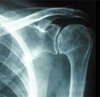 Процедура Рентген плечевого сустава