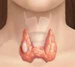Медуллярный рак щитовидной железы
