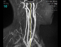 Процедура МРТ артерий шеи