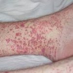 Полиморфный дермальный ангиит Полиморфный дермальный ангиит