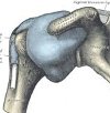Синовэктомия плечевого сустава