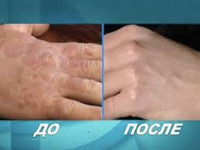 Профессиональные дерматозы Профессиональные дерматозы
