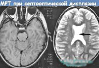 Септооптическая дисплазия 