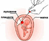 Процедура Кордоцентез