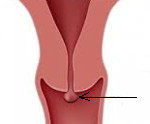 Стеноз цервикального канала в менопаузе