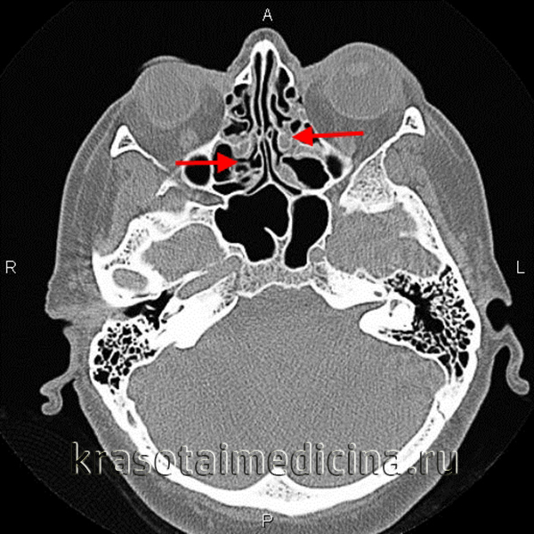 КТ придаточных пазух носа. Двухсторонний катаральный этмоидит