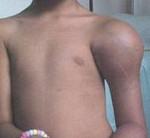Deformierende Osteitis