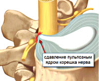 Шейный радикулит