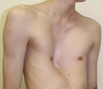 Деформация грудной клетки Деформация грудной клетки