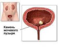 Реферат: Мочекаменная болезнь 4