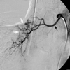 Эмболизация бронхиальных артерий