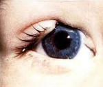 Аномалии развития глаза