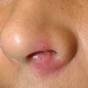 Вскрытие фурункула носа