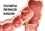 Полипы прямой кишки Полипы прямой кишки