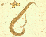 Стронгилоидоз