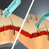Пересадка волос в рубцовую ткань (1 графт)