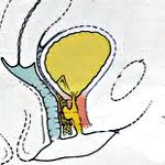 Дивертикул мочеиспускательного канала