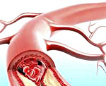 Злокачественная артериальная гипертензия