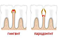 Заболевания пародонта