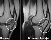 Болезнь Гоффа