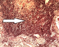 Ксантогранулематозный пиелонефрит Ксантогранулематозный пиелонефрит