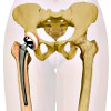 Эндопротезирование тазобедренного сустава