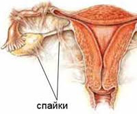 Как вылечить спайки в маточных трубах 11