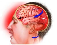 черепно мозговое давление симптомы и лечение