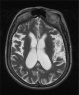 Изменения головного мозга у пациента с пигментной ксеродермой