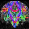МРТ-трактография головного мозга