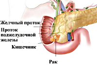 Рак Головки Фото