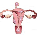 Что такое фибромиома матки: причины и симптомы болезни, методы диагностики и лечения