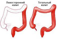 Острый колит