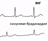 Брадикардия