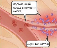 Воспаление сосудов головной мозг thumbnail