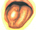 Язва при сифилисе на слизистой оболочке рта