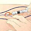 Курс склеротерапии варикозных вен с микросклеротерапией